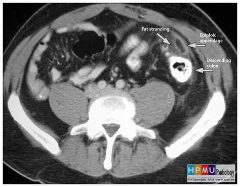 Viêm Bờm Mỡ Đại Tràng ** [111 cases]