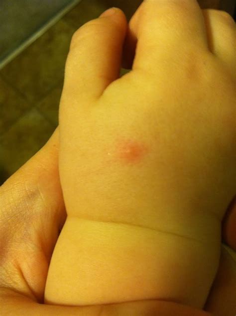 Is this normal? Rash, MRSA?! - BabyCenter