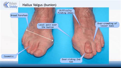 Hallux Valgus