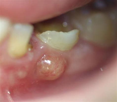 How to Drain a Gum Abscess at Home Without a Needle - YouMeMindBody