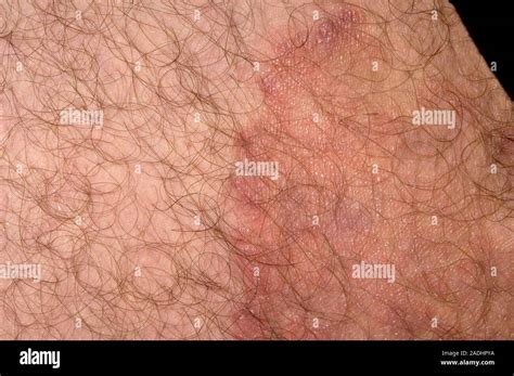 Ringworm fungal infection (dark area at right) on the skin of a 69-year-old man's groin ...