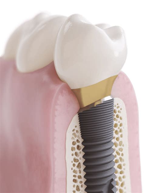 OsseoSpeed Profile EV (ASTRA TECH Implant System) - Dentsply Sirona Implants