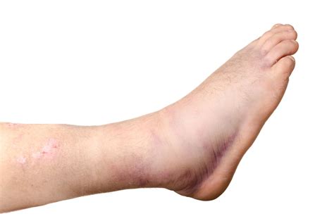 Foot & Ankle Fractures - Family Foot and Ankle Care of Greenville