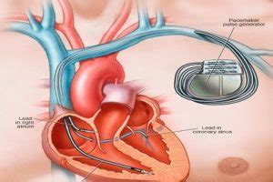 Procedures and Risks with Pacemaker Implantation – Know your Heart Blog