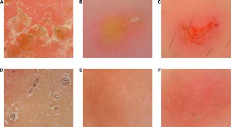 Frontiers | Dermoscopic features of children scabies