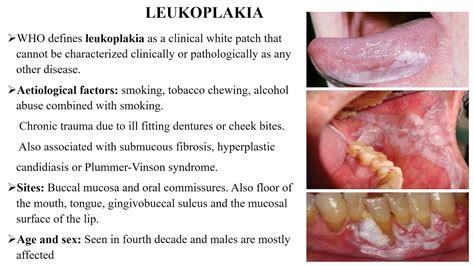 PREMALIGNANT CONDITIONS OF ORAL CAVITY - YouTube