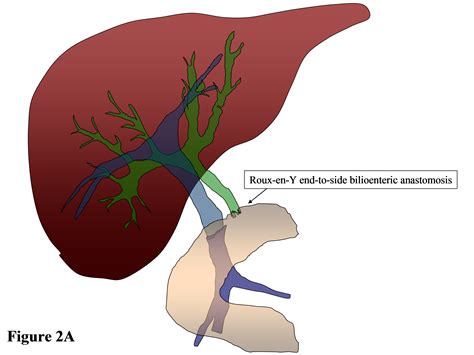 Roux-en-Y hepaticojejunostomy effective solution to biliary complications after living donor ...