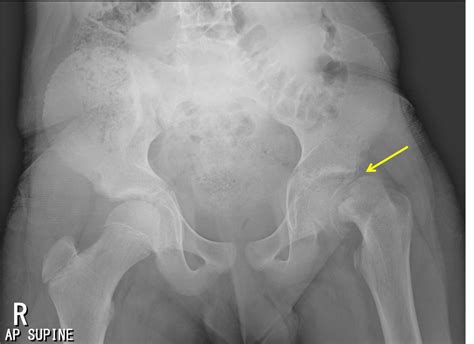 Slipped upper femoral epiphysis – Radiology Cases