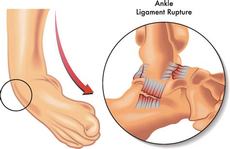 Tendon And Ligament Repair Surgery in Kondapur, Hyderabad | Apollo Spectra