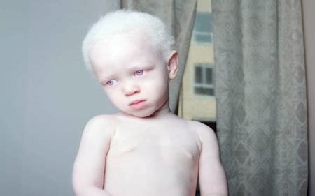 Albino Boy - Models Male & People Background Wallpapers on Desktop Nexus (Image 2414581)