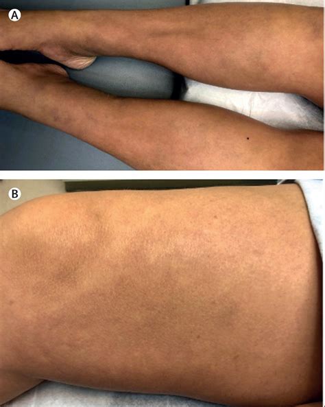 Bilateral lower extremity induration in a patient with leiomyosarcoma ...