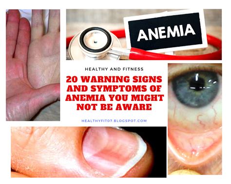 20 Warning Signs And Symptoms Of Anemia You Might Not Be Aware