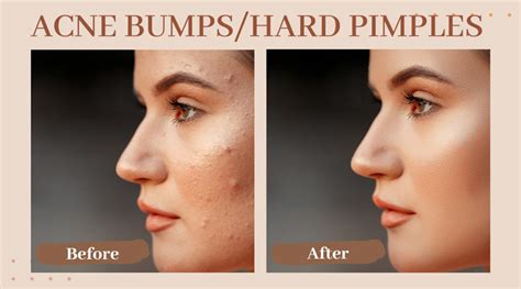 How to Get Rid of Acne Bumps or Hard Pimples?