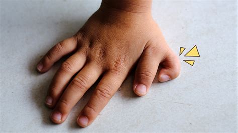 Bayi Mengalami Polydactyly: Jumlah Jari Lebih Dari Normal | Orami