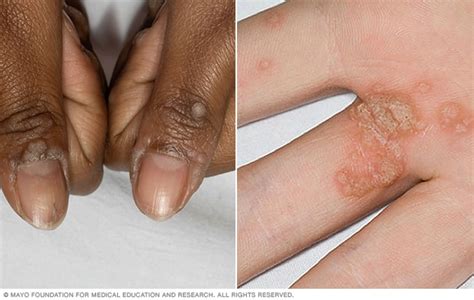 Common warts - Symptoms and causes - Mayo Clinic