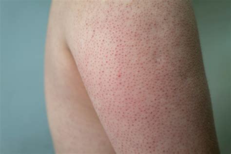 Kokeratosis Pilaris - Aura Dermatology