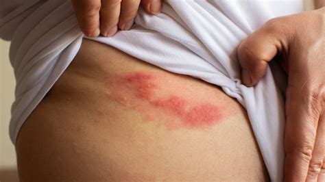 What is the painful condition called shingles? - Medical Follower