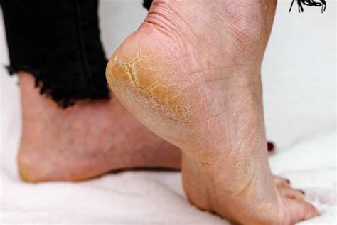 How to Remove Dry Skin on Feet | Doncaster Foot Clinic