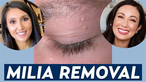 How Do You Remove Milia? A Dermatologist Shares Milia Treatment & Prevention Tips | DERM CHAT ...