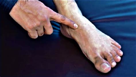 Navicular fracture causes, symptoms, diagnosis, treatment & prognosis