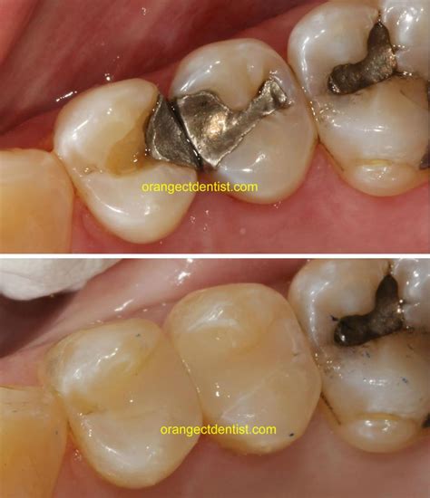 Silver Filling Removal | Mercury Amalgam | Dentist Orange, CT