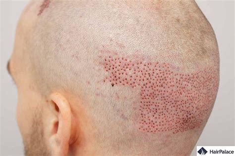 Hair Transplant Holes and Trypophobia | Causes and Treatments