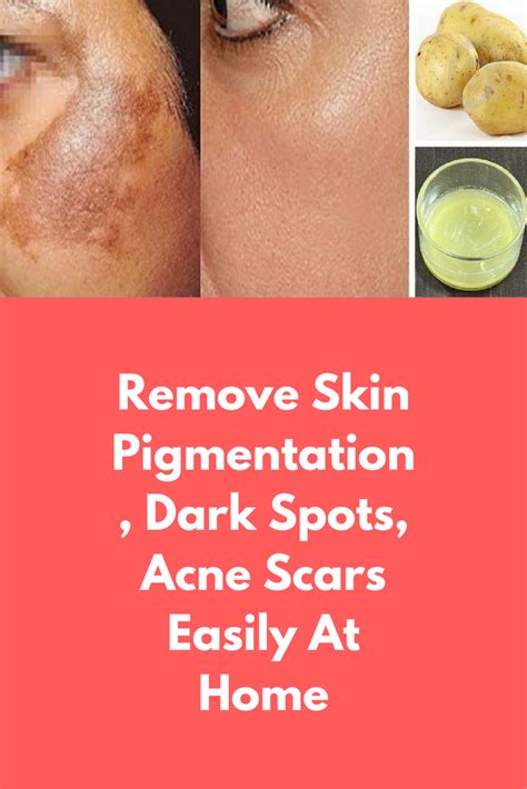 4 Home Remedies To Remove Skin Pigmentation | Justinboey