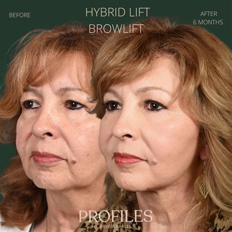 Best Facelift Surgeon Los Angeles | Facelift Beverly Hills