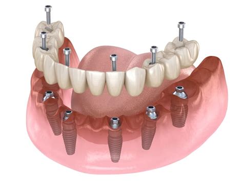 All on 6 Dental Implants San Diego | Smile Designers San Diego