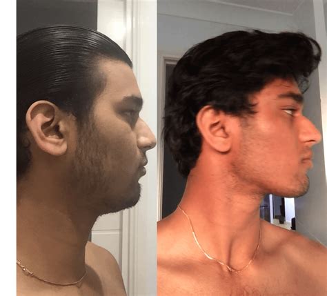 19M 4 month mewing + 2 month chewing (mastic gum) progress : r/Mewing