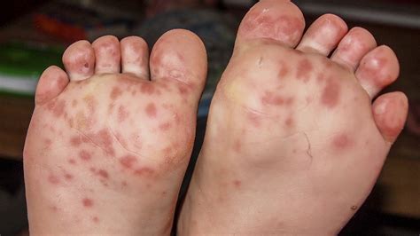 How To Cure Foot And Mouth Disease - Dreamopportunity25