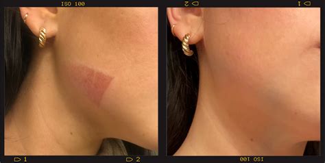 How To Cover A Burn Blister With Makeup - Mugeek Vidalondon