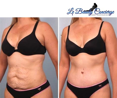 Top Reasons to Try Body Contouring - Le Beauty Concierge Body