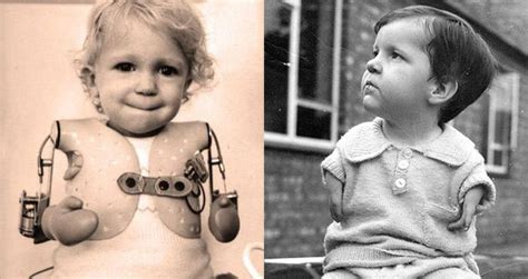 Thalidomide Babies And The Company That Was Responsible For Them