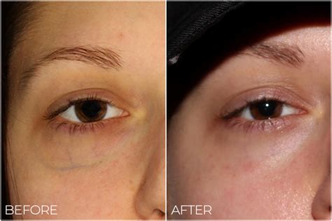 Say Goodbye to Pesky Under Eye Veins | Vein Specialists of the South