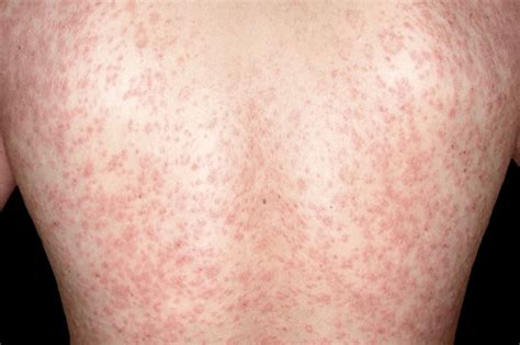 Pitiríase rósea - Dermatologia