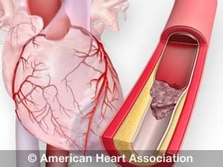 Heart Attack and Sudden Cardiac Arrest Differences | American Heart ...