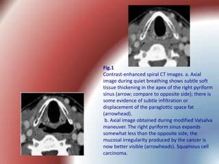 Cancer of the hypopharynx