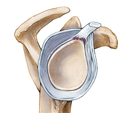 Glenoid Labrum Slap Tear