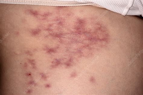 Panniculitis - Stock Image - C051/3990 - Science Photo Library