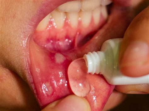 Are Benign Mouth Lesions Mostly Cancerous?
