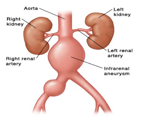 รายการ 98+ ภาพ Abdominal Aortic Aneurysm อาการ ใหม่ที่สุด