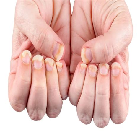 Abnormal Nail Symptoms and Causes - medikstar