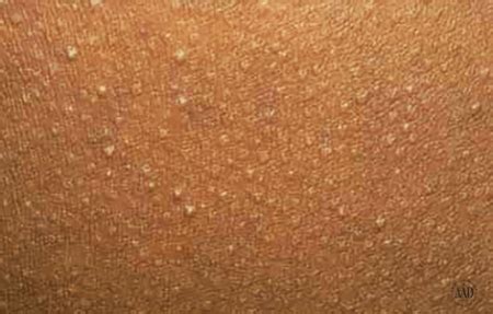 Keratosis pilaris: Signs and symptoms