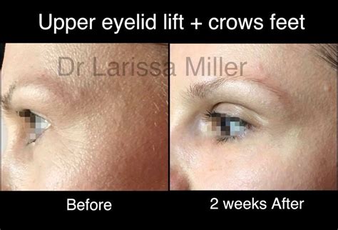 DROOPY EYELIDS CONCERNS - Vista Clinic Melbourne