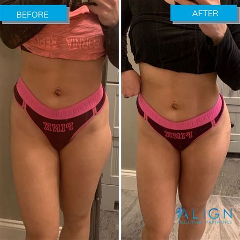 Before and After Non-Surgical Treatment of Hip Dips | Align Injectable Aesthetics