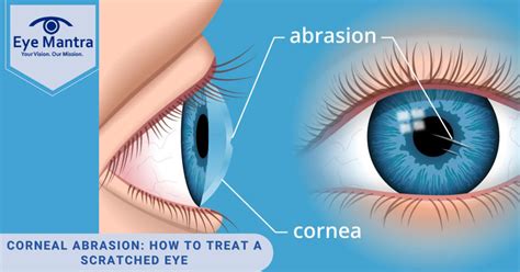 Corneal Abrasion: How to Treat a Scratched Eye | Eyemantra Hospital