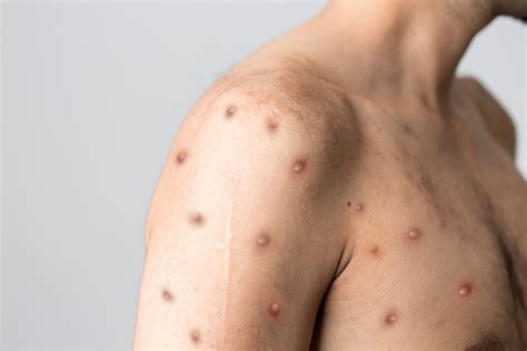 As Monkeypox Virus Cases Grow, Watch for the Rash & Other Symptoms