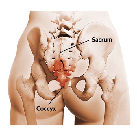 Chiropractic Management of Coccydynia — ChiroUp