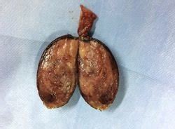 Red Currant Jelly Stool Intussusception - Cuvânt